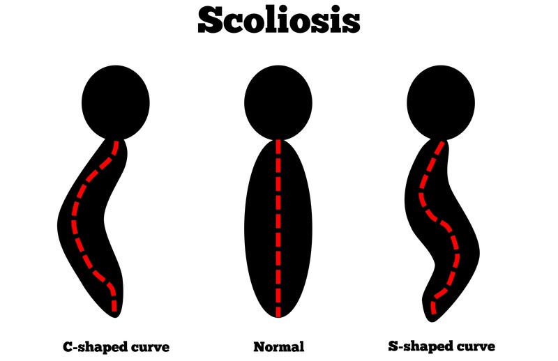 Brunswick, ME scoliosis treatment